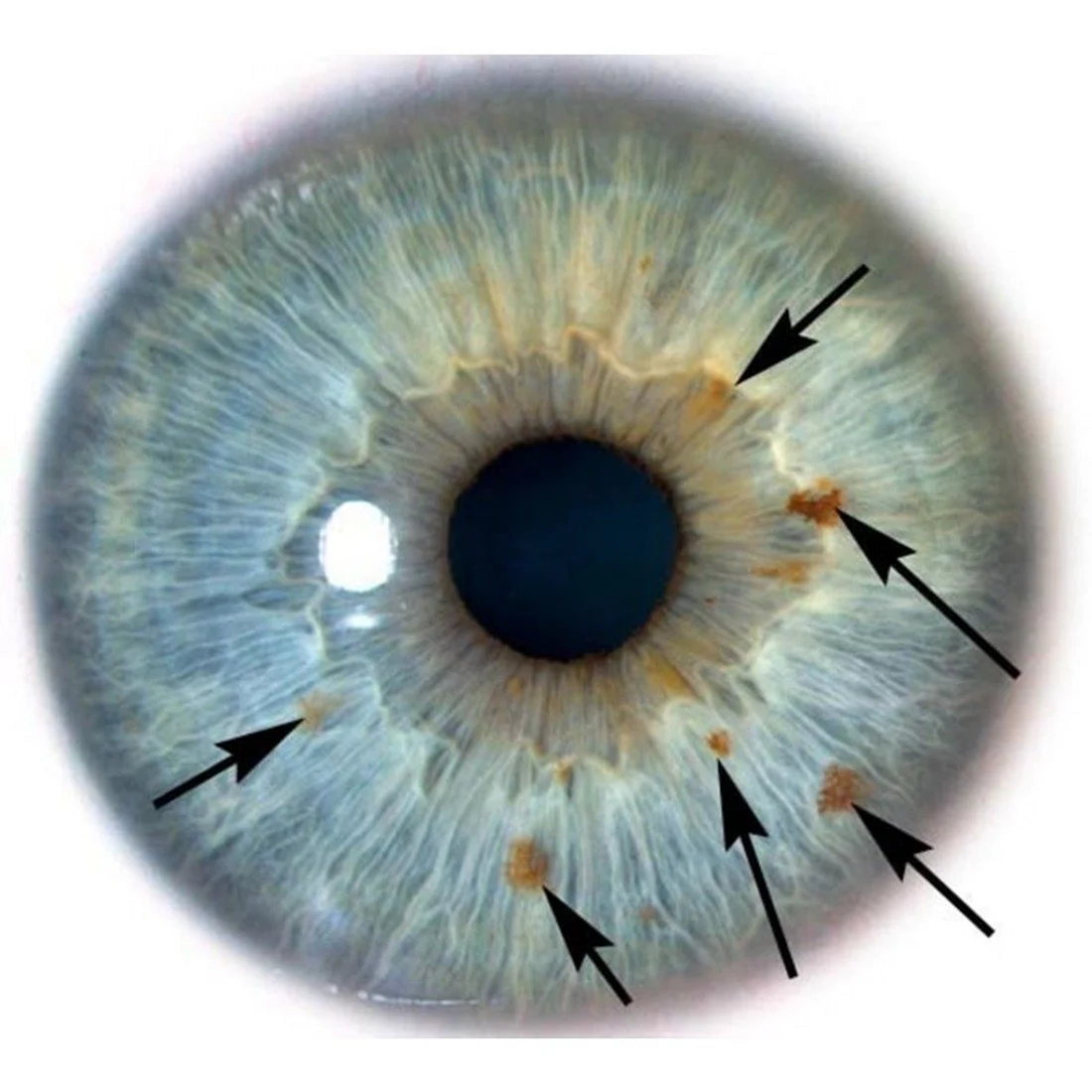 Зрачок это дырка. Меланома конъюнктивы офтальмология. Радужки глаз иридодиагностика. Мезодермальная дистрофия Радужки. Гетерохромный иридоциклит Фукса.