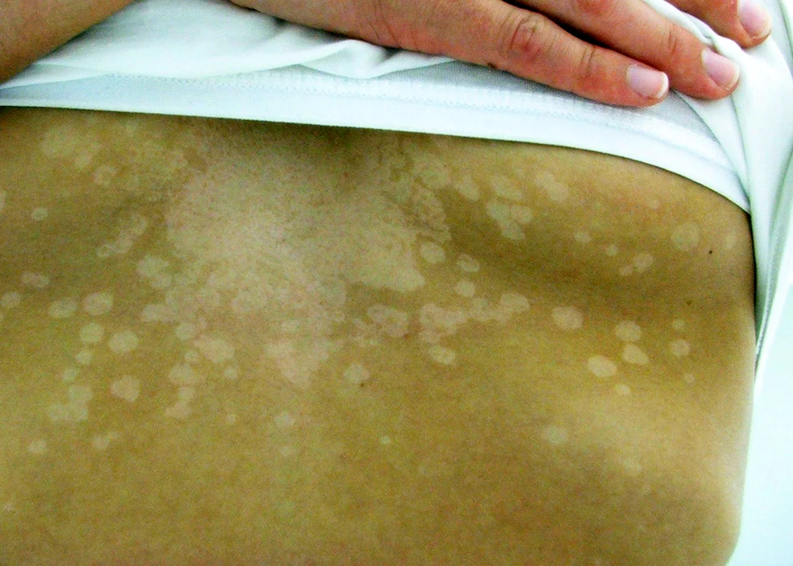 Лишаешься самой. Сифилитическая лейкодерма. Pityriasis versicolor отрубевидный лишай. Отрубевидный (разноцветный лишай) лишай. Отрубевидный лишай - Pityriasis versicolor (Tinea versicolor).